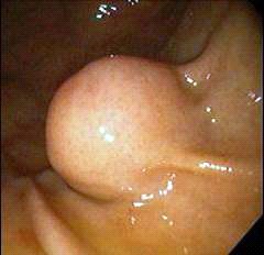 קובץ:Gastriccarcinoma18.jpg