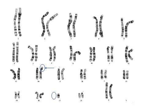 קריוטיפ של אשה עם טרנסלוקציה מאוזנת בין כרומוזום 14 לכרומוזום 21