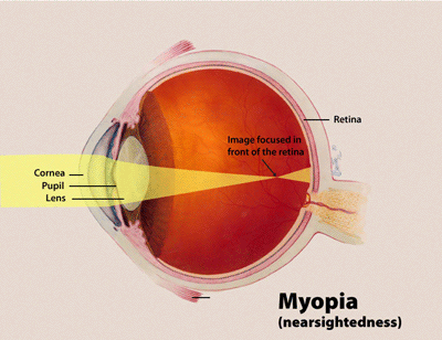 קובץ:Myopia.gif