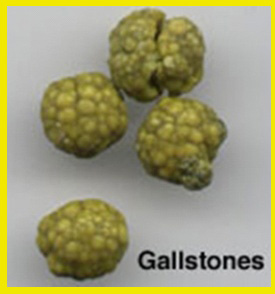 Gallstone2.jpg