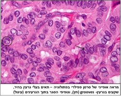 Papillary thyroid carcinoma.jpg