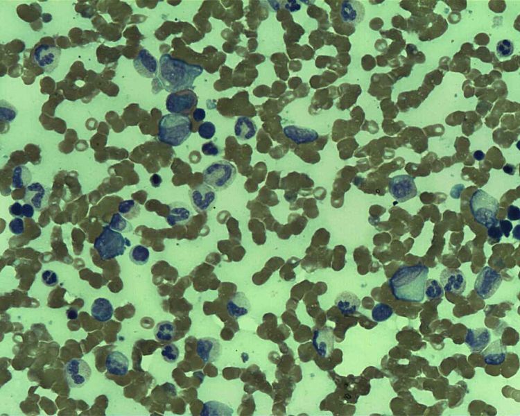 קובץ:Marrow Follicullar lymphoma.jpg