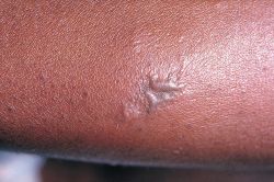 Gonococcal lesion on the skin PHIL 2038 lores.jpg