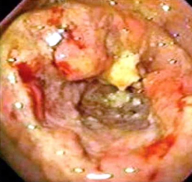קובץ:Gastriccarcinoma163.jpg
